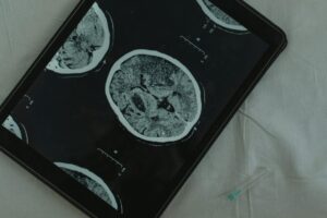 Bóle neuropatyczne – przyczyny, objawy i&nbsp;nowoczesne leczenie